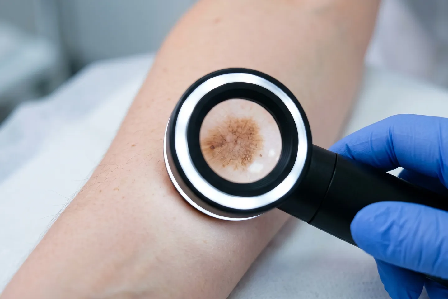 World’s largest genetic study of ‘moliness’ helps unravel mysteries of melanoma