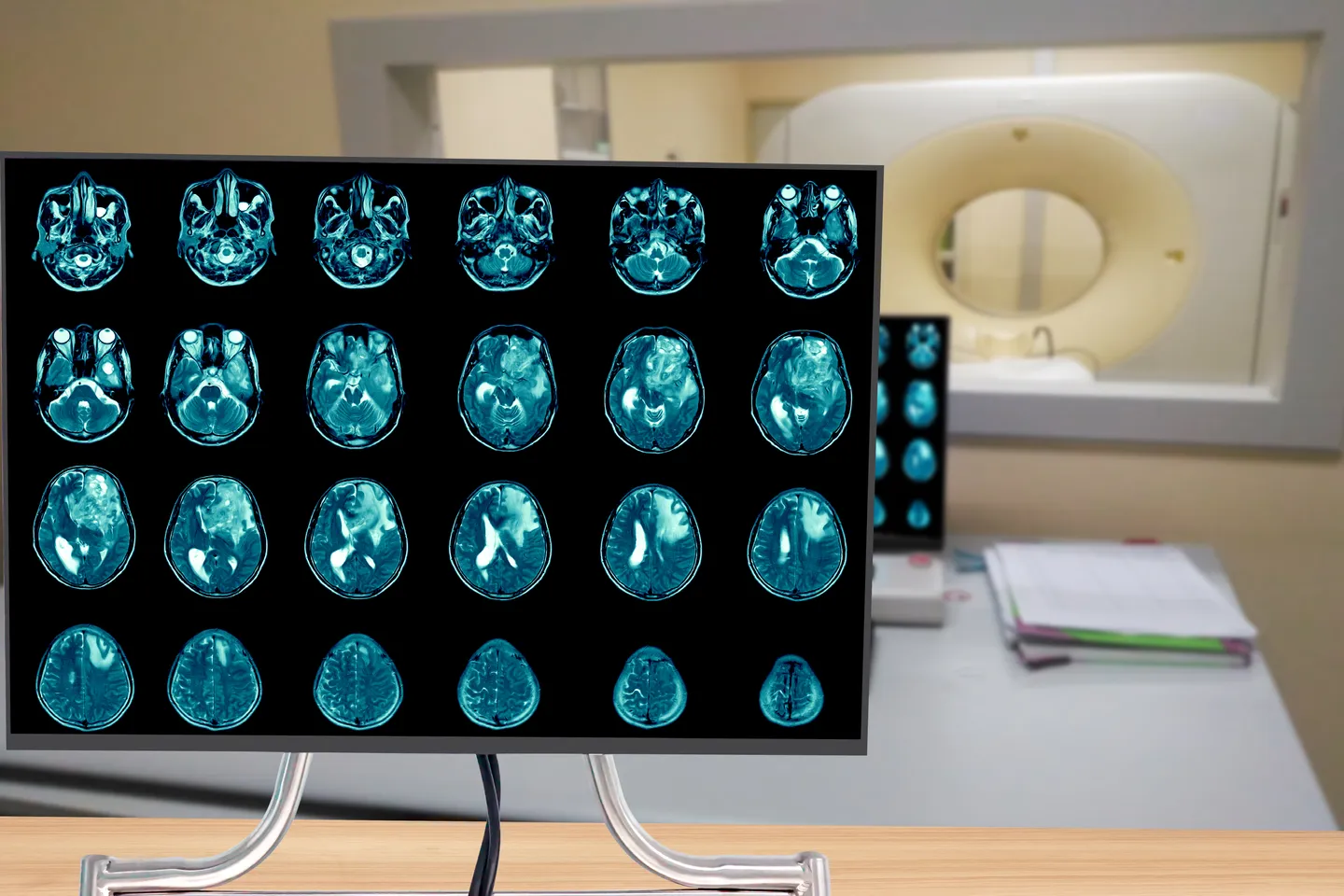 Cyteph completes recruitment for Phase I clinical trial of CYT-101 in patients with recurrent glioblastoma multiforme