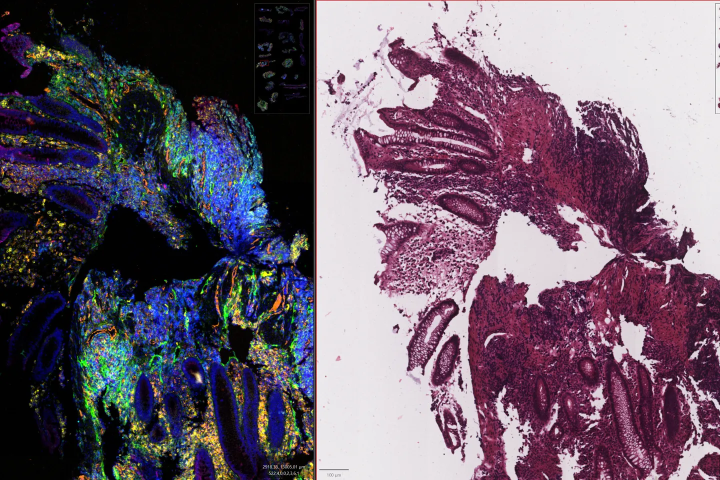 AI screening tool gives pathologists ‘spatial super vision’ to detect hidden cancer