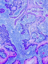 Cancer Control - web graphic
