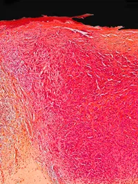 Genetics and skin cancer - melanoma image