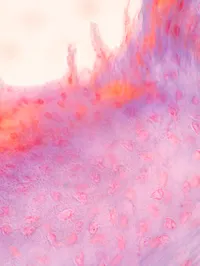 Inflamed lung tissue