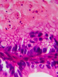 Ovarian cancer