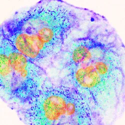 Pancreatic Cancer cells