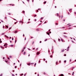 Brain Cancer cells