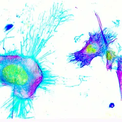 Breast cancer cells