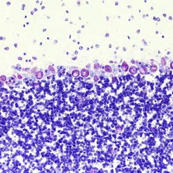 Cerebellar Ataxia - brain cells