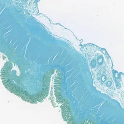 Colorectal Cancer - Web Graphic