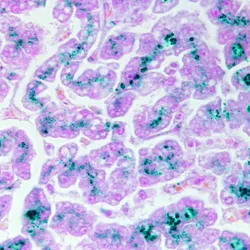Haemochromatosis under a microscope