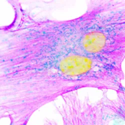 Hepatic fibrosis and cirrhosis research - web graphic
