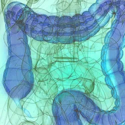 Inflammatory Bowel Disease