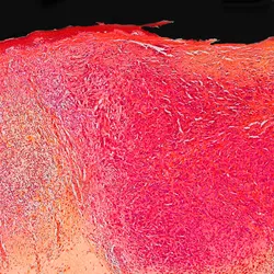 Melanoma and Other Skin Cancers - web graphic