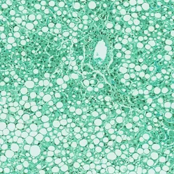 Liver Cancer - web graphic