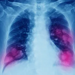 Lung Cancer and Mesothelioma - web graphic