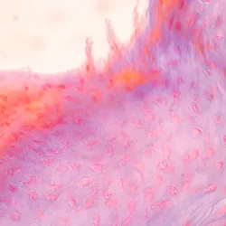 Inflamed lung tissue