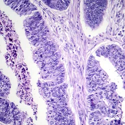 Oesophageal Cancer Web Graphic