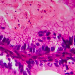 Ovarian cancer