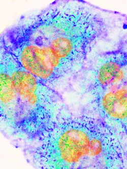 Pancreatic Cancer cells