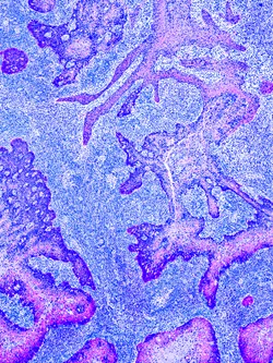 Cancer Control - web graphic