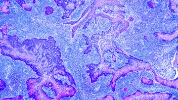 Cancer Control - web graphic