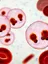 Malaria infection in blood cells