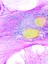 Hepatic fibrosis and cirrhosis research - web graphic