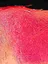 Melanoma and Other Skin Cancers - web graphic