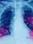 Lung Cancer and Mesothelioma - web graphic