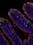 B-lymphocytes in Autoimmunity and Malignancies - web graphic