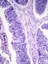 Oesophageal Cancer Web Graphic