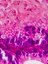 Ovarian cancer