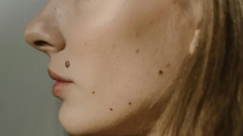 Immune system plays a role in mole formation and melanoma risk