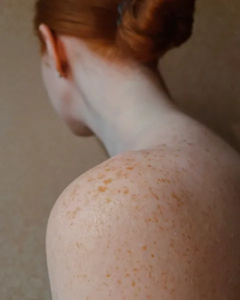 QIMRB-skin-cancer