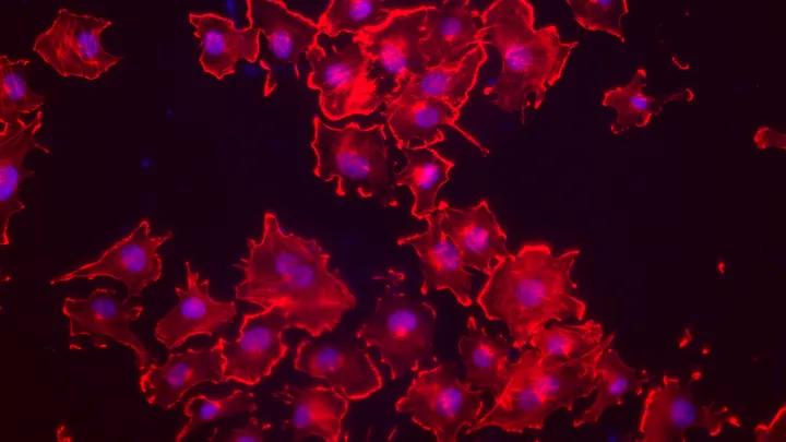 Brain cancer cells