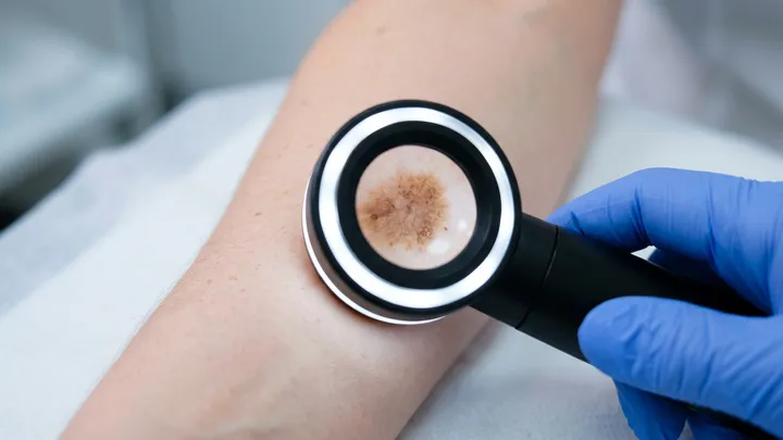 World’s largest genetic study of ‘moliness’ helps unravel mysteries of melanoma