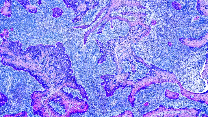Cancer Control - web graphic