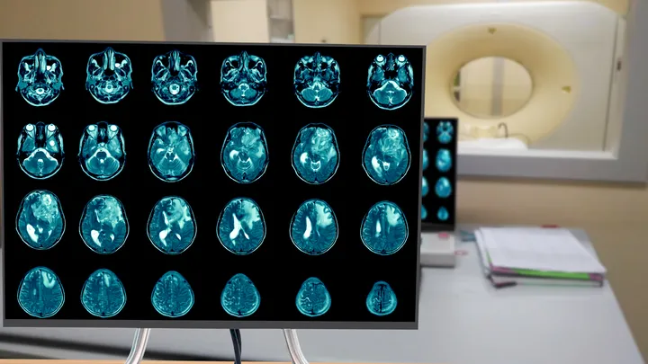 Cyteph completes recruitment for Phase I clinical trial of CYT-101 in patients with recurrent glioblastoma multiforme