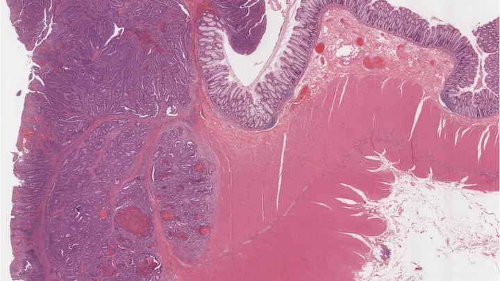 Colon cancer