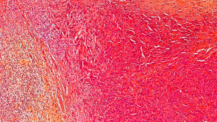 Melanoma and Other Skin Cancers - web graphic