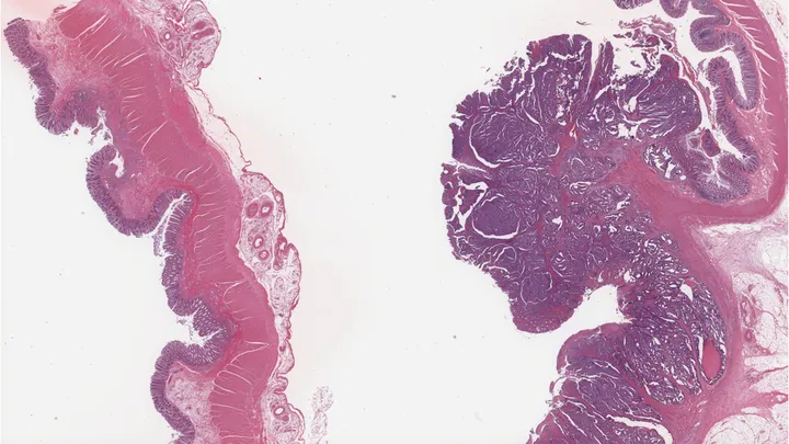 Healthy colon (left) vs colon cancer (right)