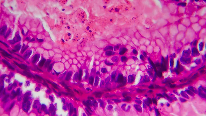 Ovarian cancer