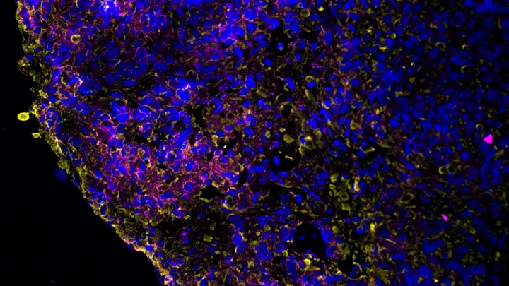 A tumor clice