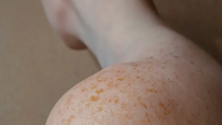 QIMRB-skin-cancer