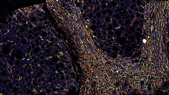 Spatial proteomic profiling of liver fibrosis