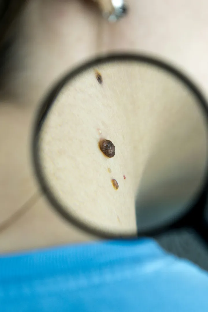 A melanoma 