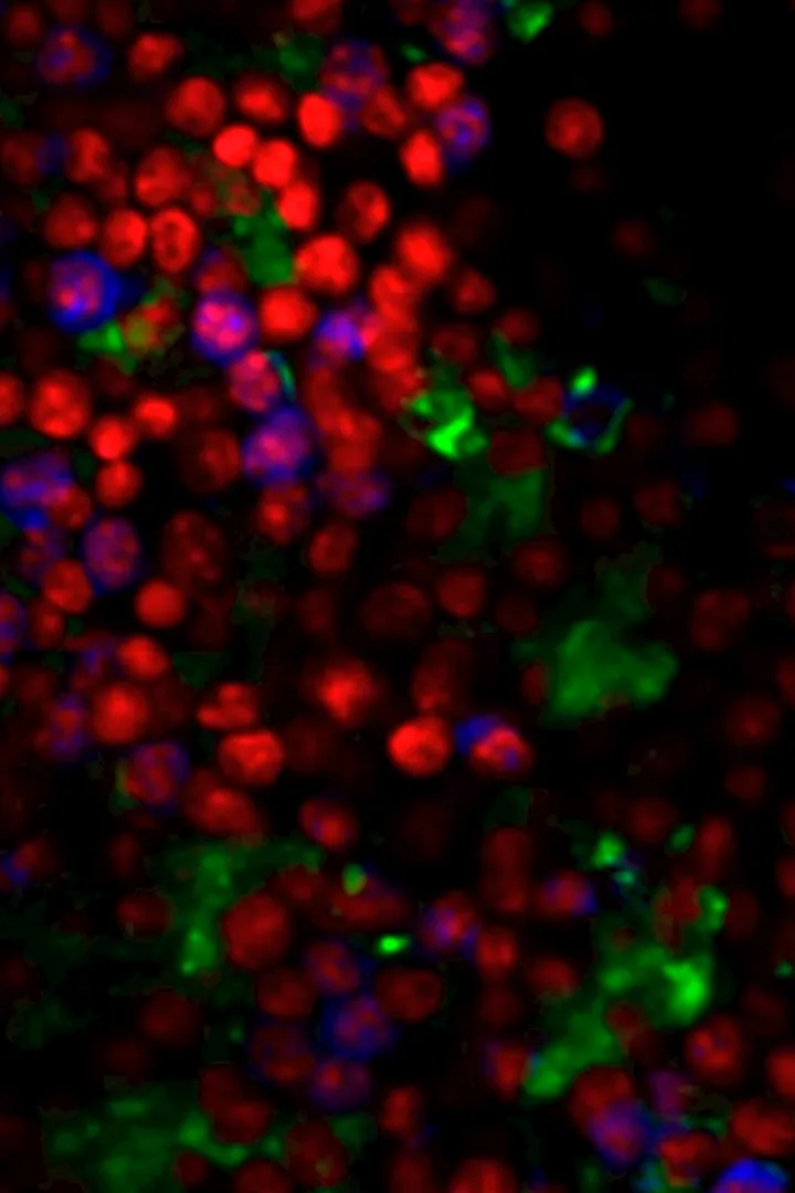 Blood cancer cells with dye