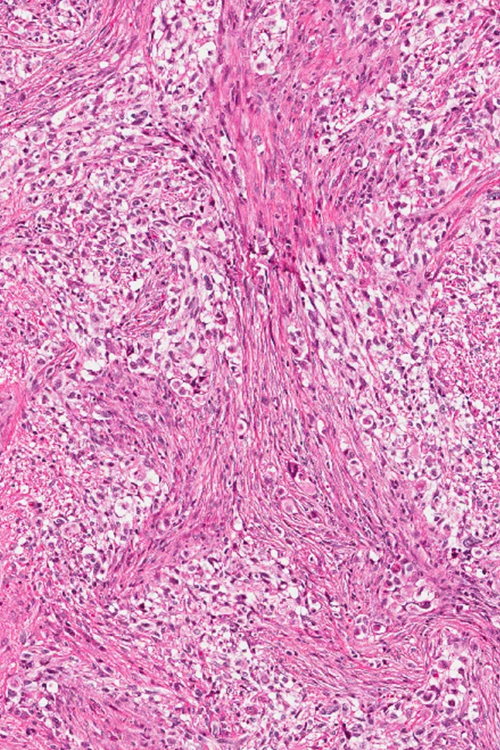 Cancer cells