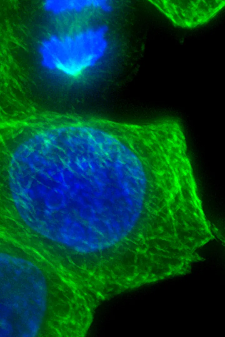 Breast cancer cells under a microscope
