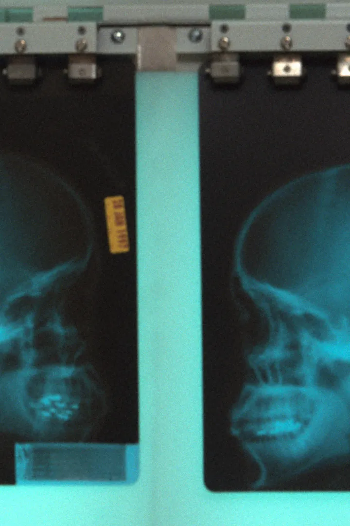 X-ray of a skull