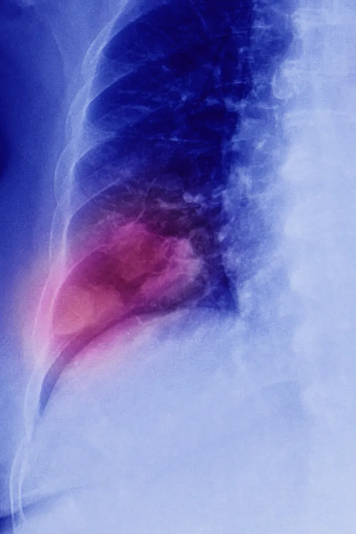 Lung Cancer and Mesothelioma